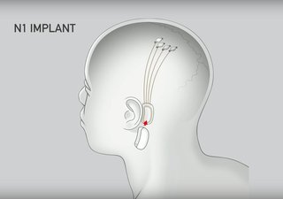 The behind-the-ear implant, called "N1," can be inserted through a 2mm incision behind the ear. The surgery can be performed while the patient is awake, and it's supposedly about as traumatic as LASIK. 